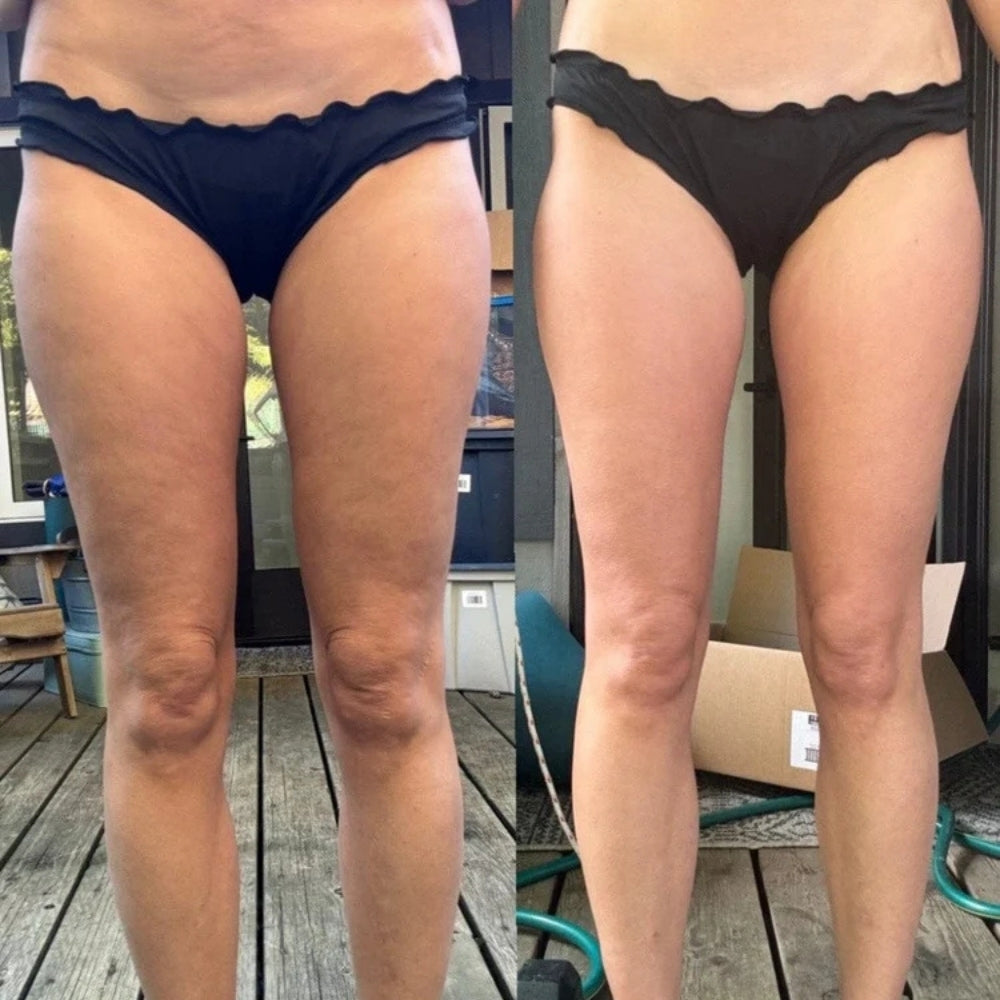 Zentrei™ - Anti-Cellulite Massager