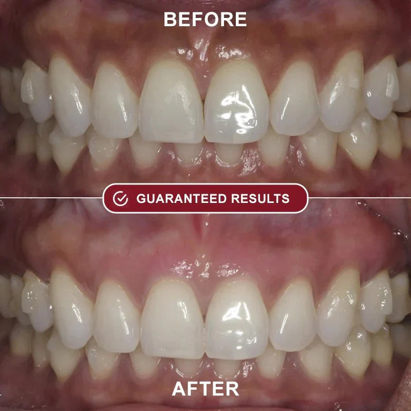 Zentrei™ - Teeth Whitening Kit
