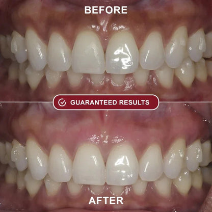 Zentrei™ - Teeth Whitening Kit